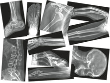 Broken Bones X-Rays