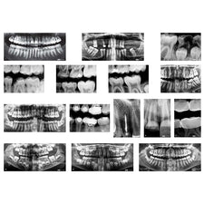 Dental X-Rays 